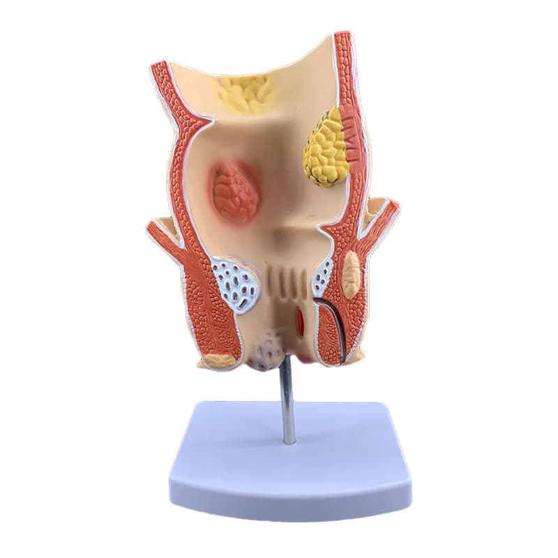 Hemorrhoid rectal pathological model, enterorectal anatomical pathological model pathological disease teaching aids