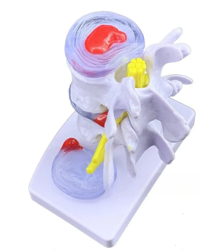Disc herniation model Bone pathology model