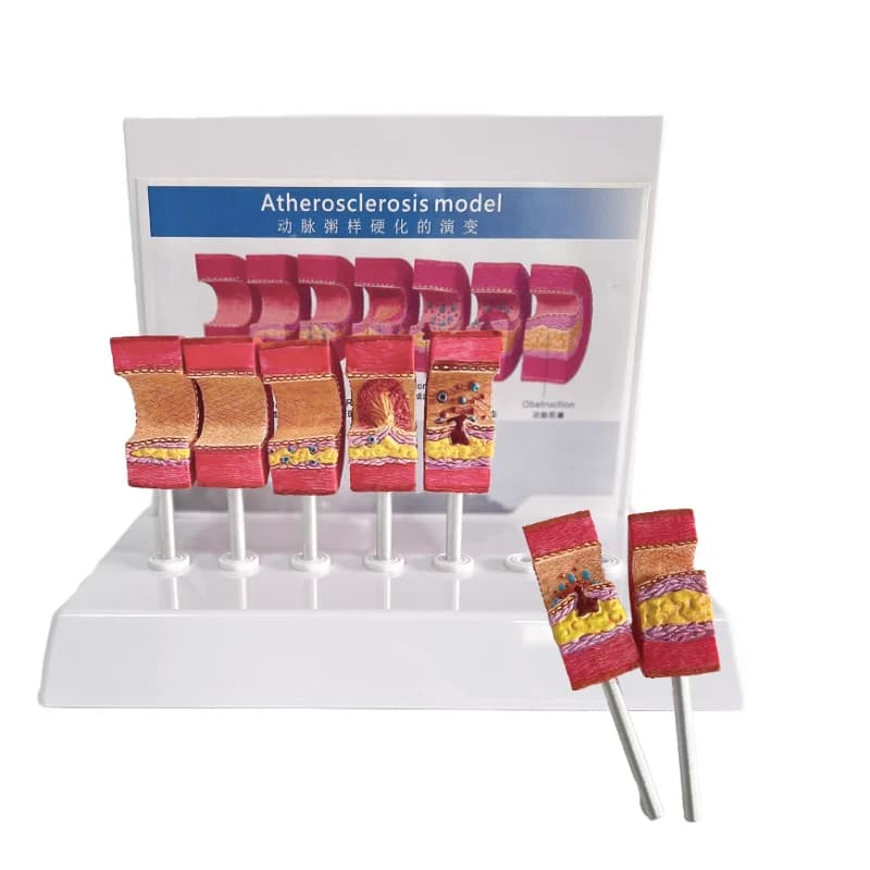 7-node atherosclerosis model vascular thromboembolism demonstration model
