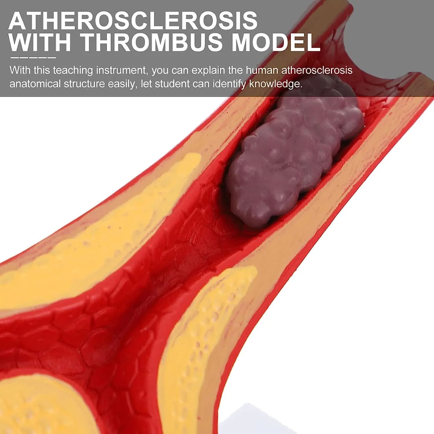 Human Atherosclerosis Cardiovascular Vascular Anatomy Teaching Model