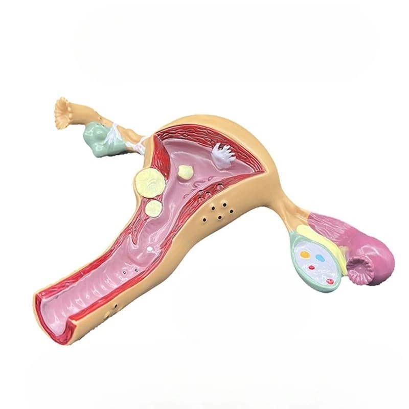 Uterine and ovarian model disease medical demonstration anatomical model