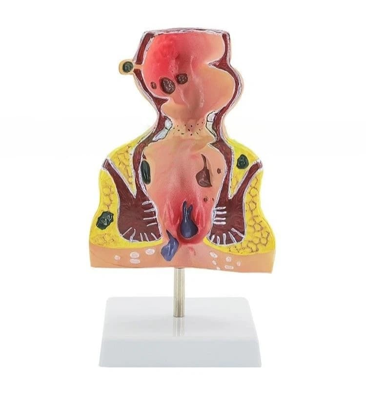High-quality model of colorectal colic lesions with rectal hemorrhoids