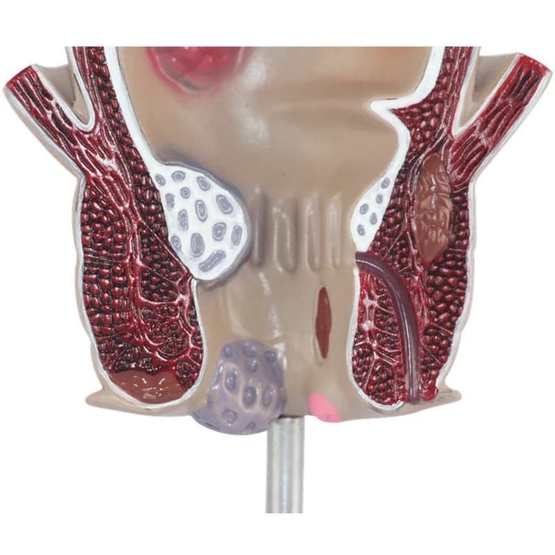 The anorectal anatomical model displayed by the pathological model of anorectal acne in medical teaching