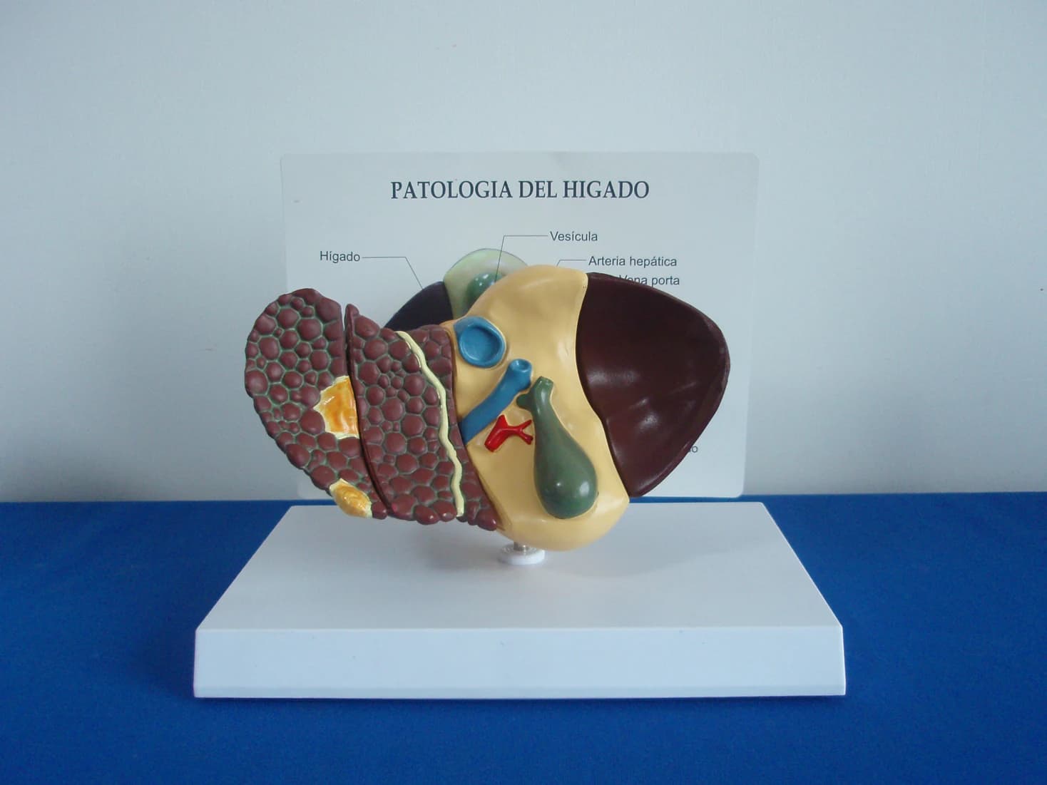An anatomical model of chronic hepatitis for medical students with liver disease