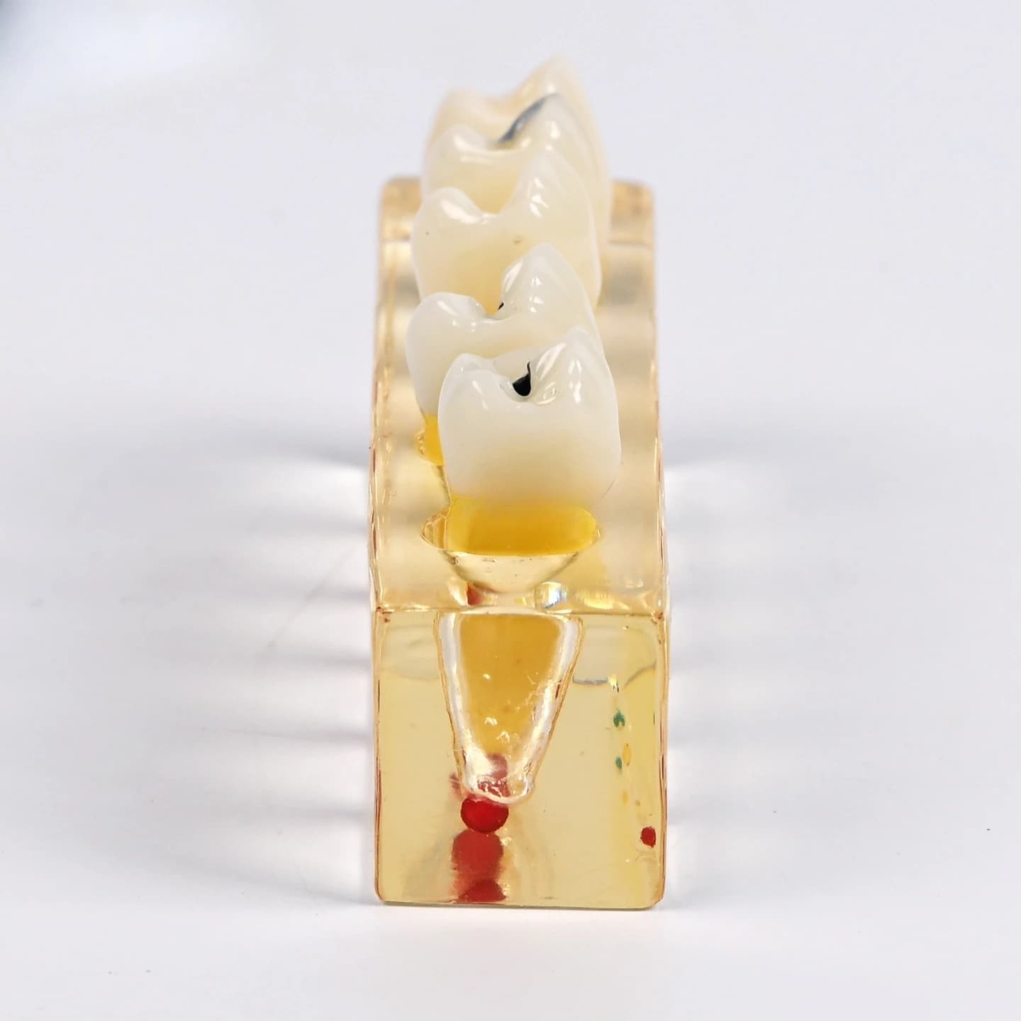 Dentals pathological treatment model dentals caries disease model