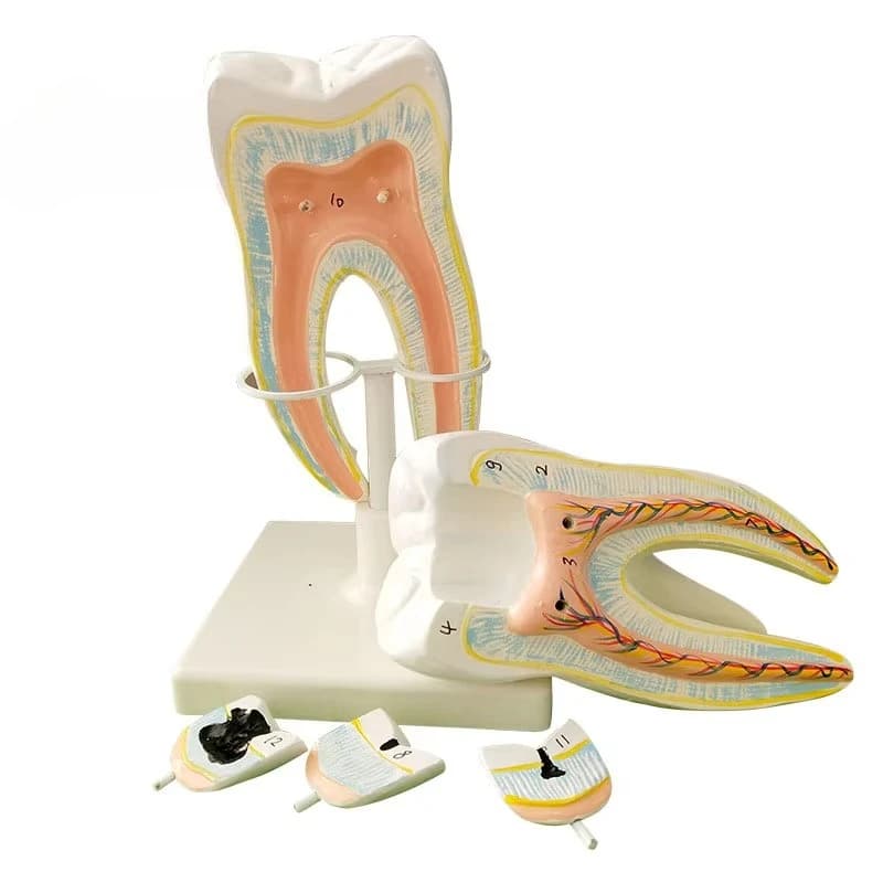 10 times large tooth pathological cavity anatomy model removable molar caries teaching dentals model