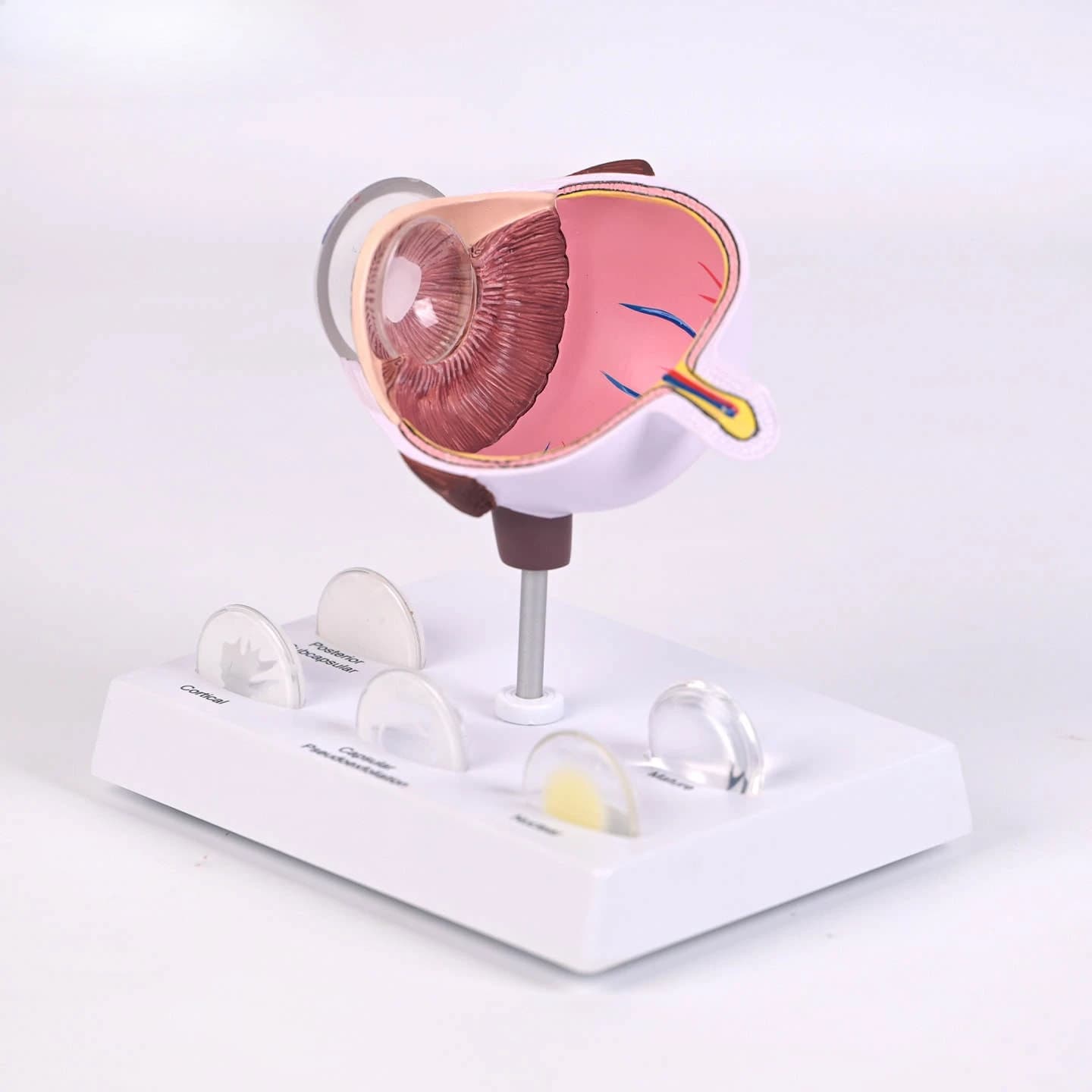 Medical cataract eye model eye anatomy pathology lens opacity ophthalmology teaching