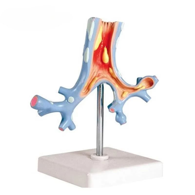 Bronchial pathology model Anatomical model Medical teaching aid model