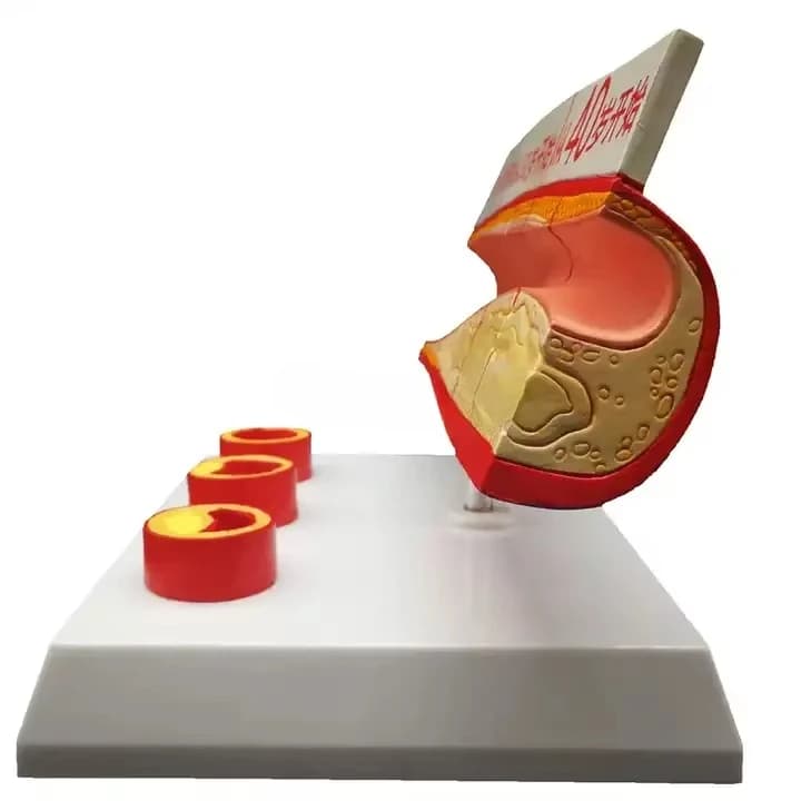 Anatomy Teaching of Coronary Atherosclerosis Thrombosis Model in Medical Disciplines