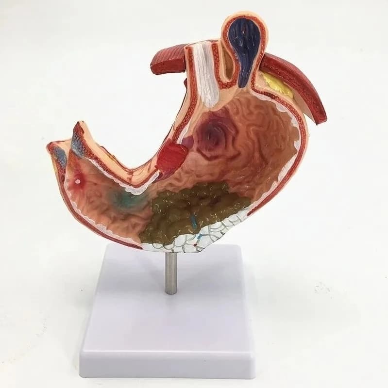 Diseased Stomach Model with Diaphragm Demonstration Model Pathological Stomach Model Ulcer/Ulcer Stomach