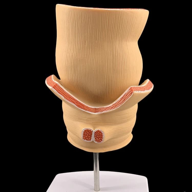 Rectal pathological model of hemorrhoids Ulcerative colon disease Rectal anatomical pathological model