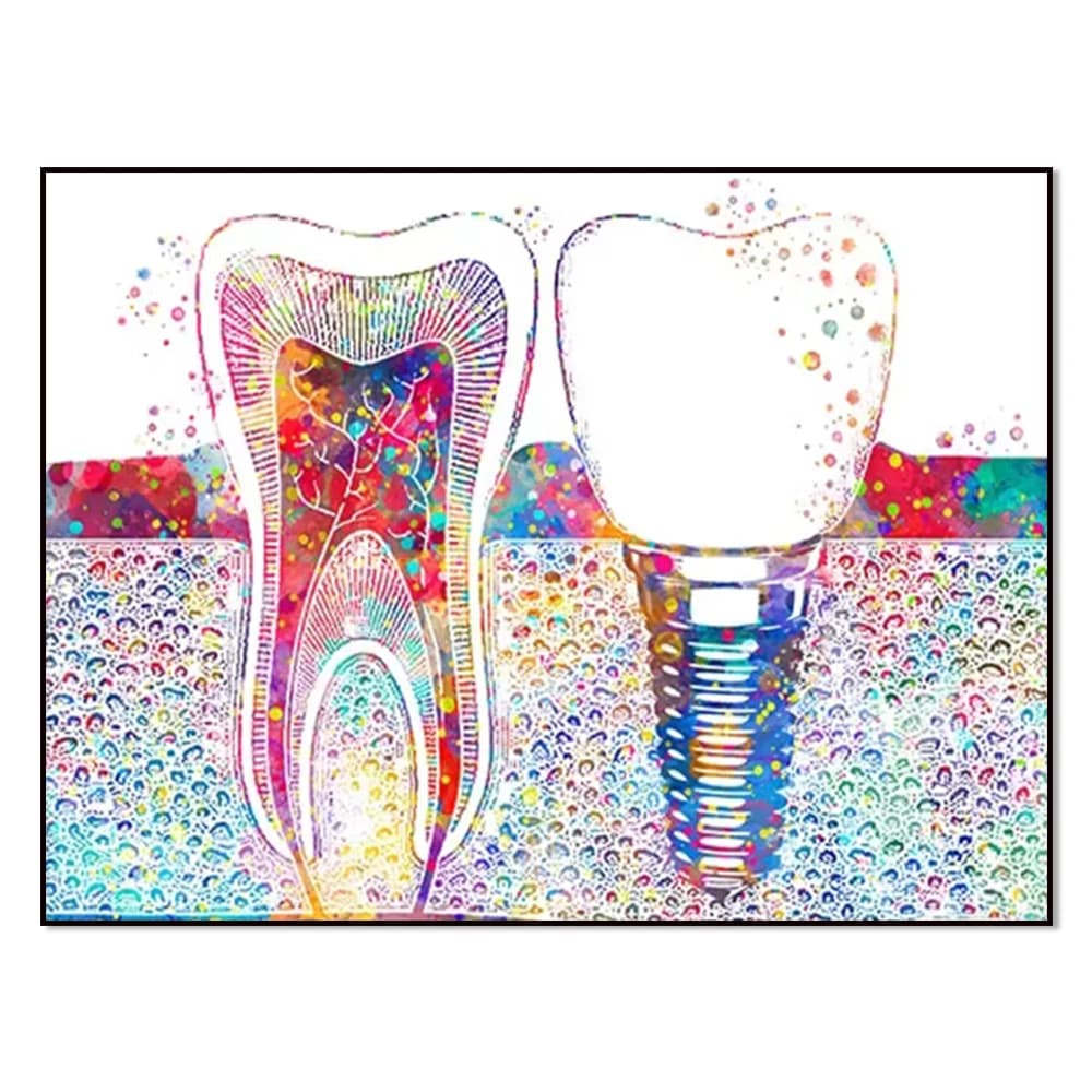 Dental Art Picture Tooth Implant Canvas Print Dentist Wall Art Painting Medicine Hygienist Poster Tooth Clinic Decor
