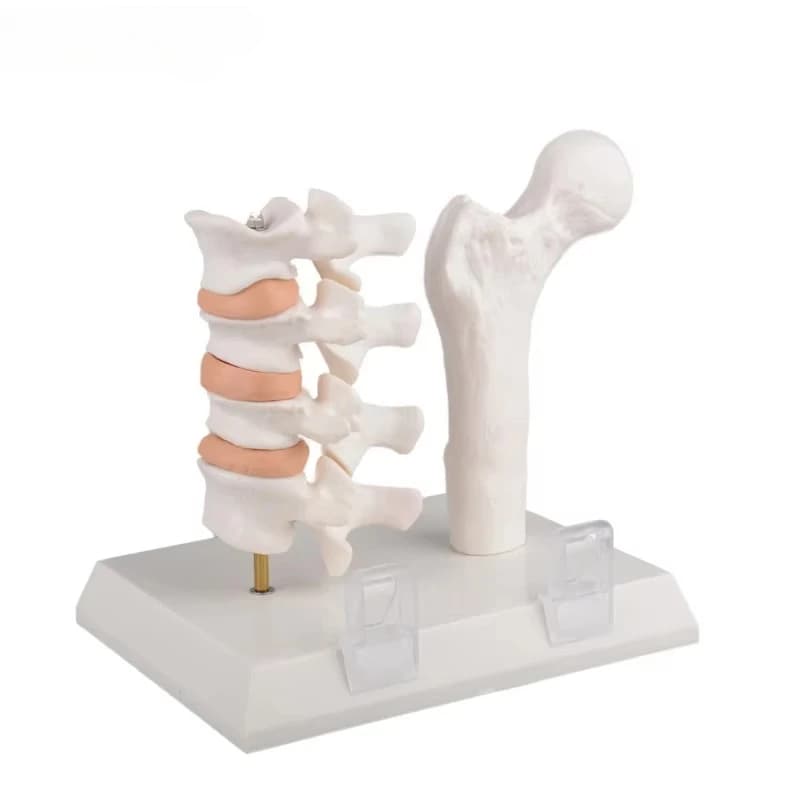 Osteoporosis Model of Femur and Lumber Bone Fracture Anatomy Model for Medical Science Classroom Education