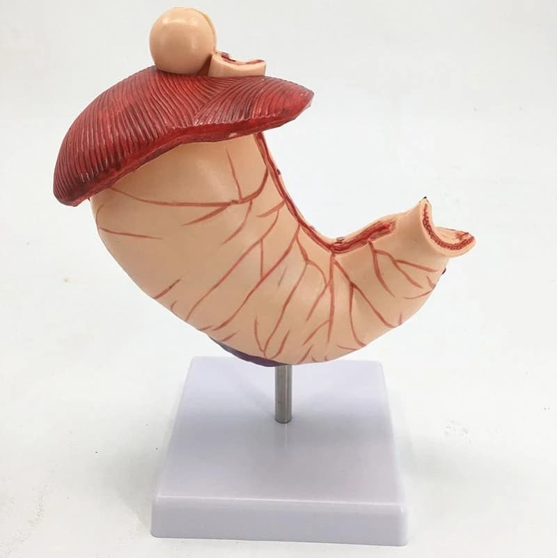 Diseased Stomach Model with Diaphragm Demonstration Model Pathological Stomach Model Ulcer/Ulcer Stomach
