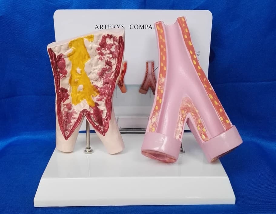 Arterys Comparison Smoking Vessels and Normal Vessels Model Human Vascular Medical Teaching Model